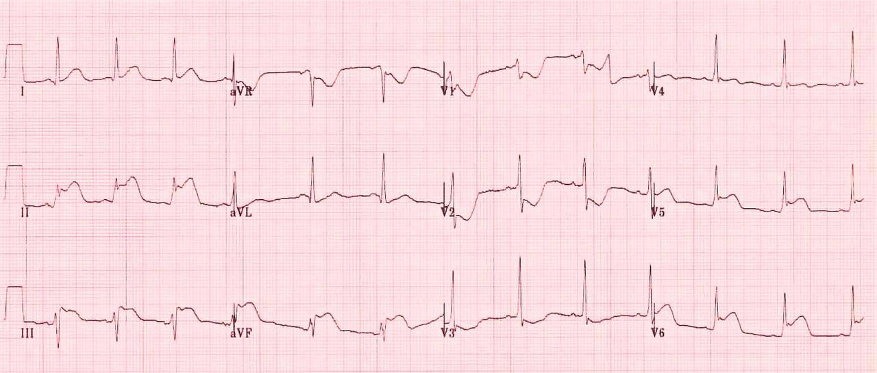 STEMI - Inferolateral