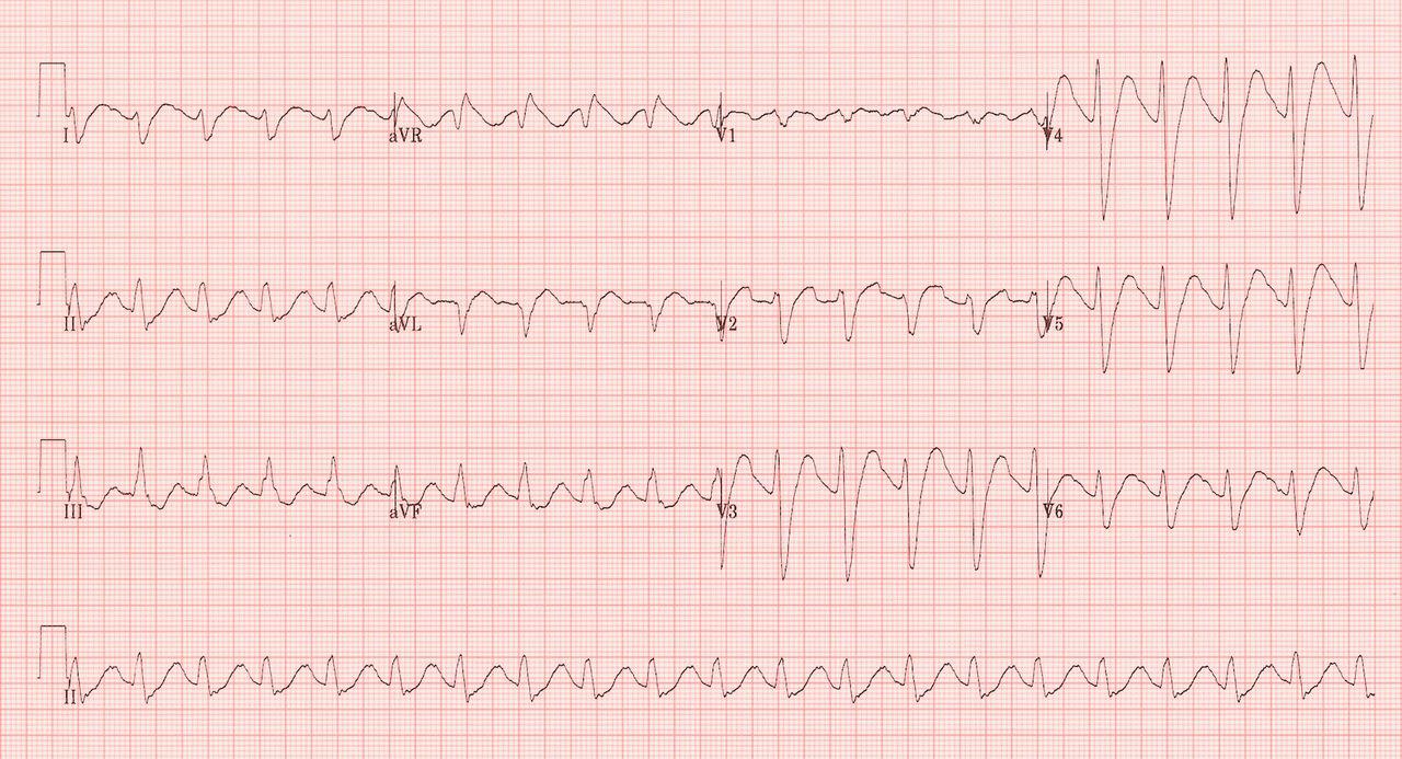 Tricyclic Toxicity