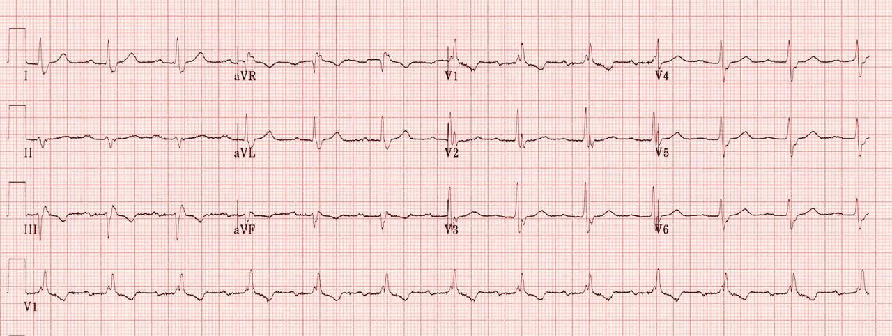 Trifasicular Block