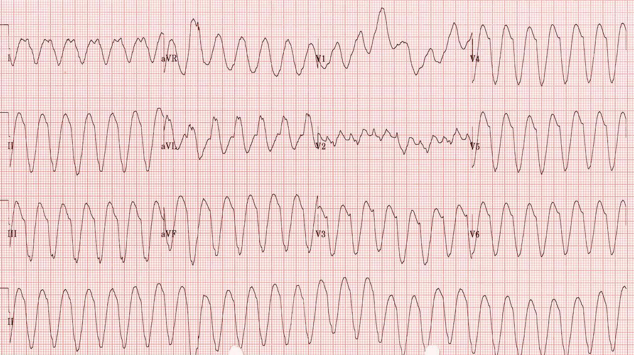 Ventricular Tachycardia