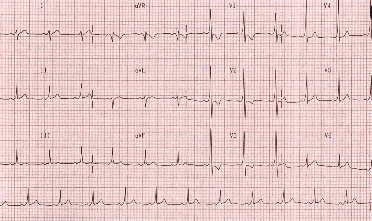 Wolff Parkinson White