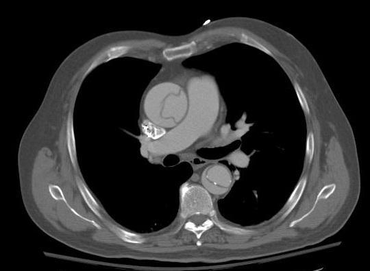 Aortic Dissection