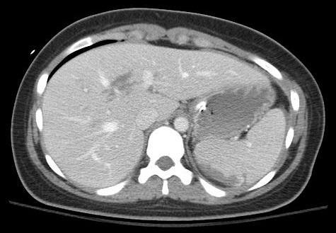 Hepatosplenic Trauma