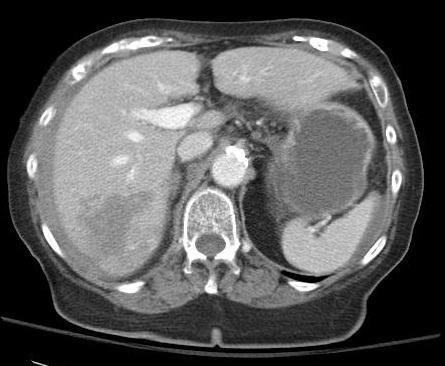 Liver Laceration