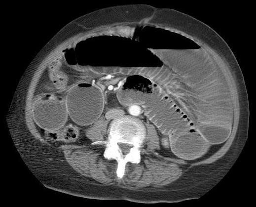 Small Bowel Obstruction