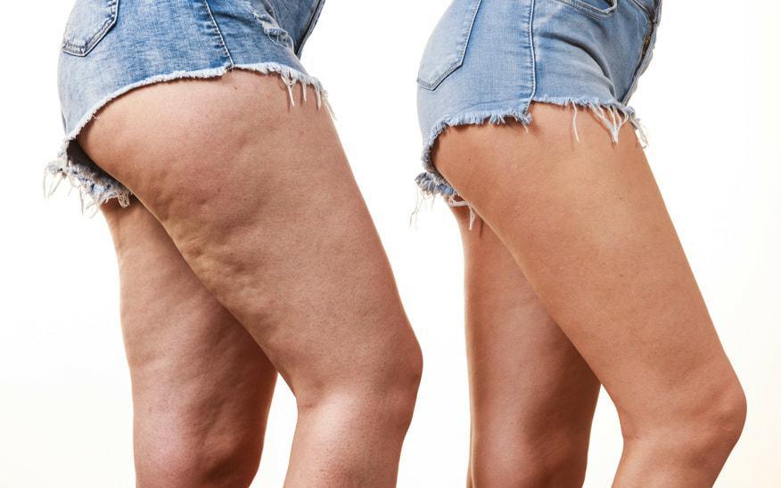 Comment éviter la cellulite ?