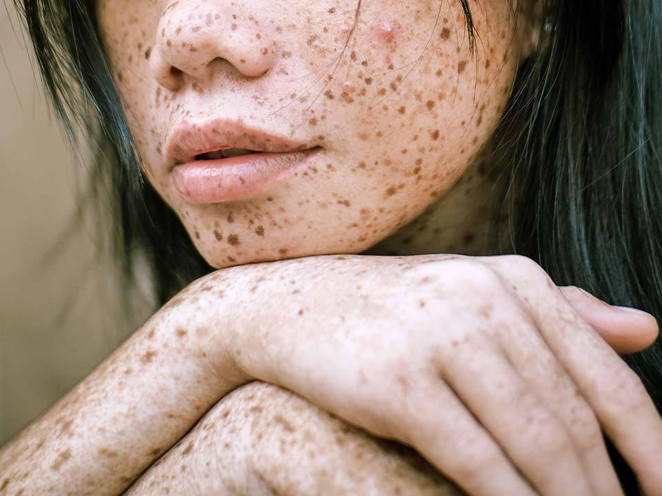 Soleil : Comment échapper aux tâches brunes ?