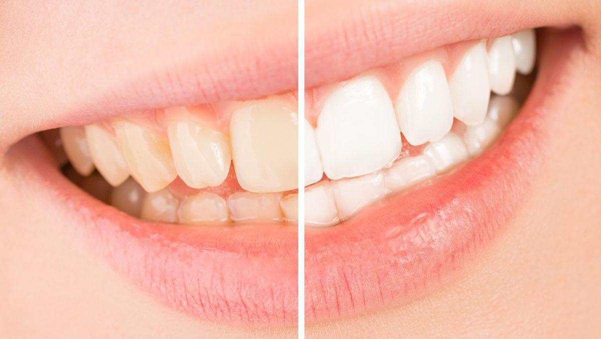 Comment blanchir ses dents sans les abîmer ?