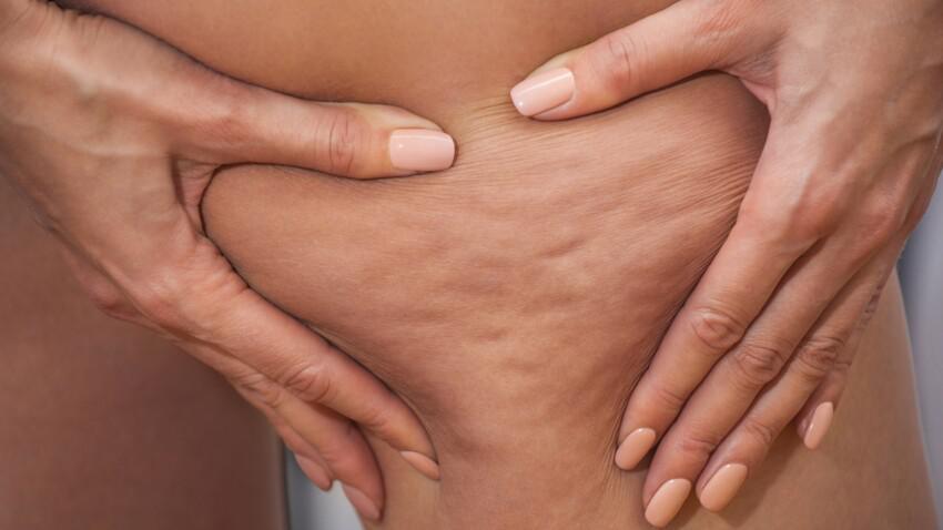 Comment combattre la cellulite ?