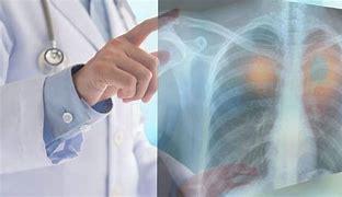Pollution : La compréhension du cancer du poumon fait une avancée majeure