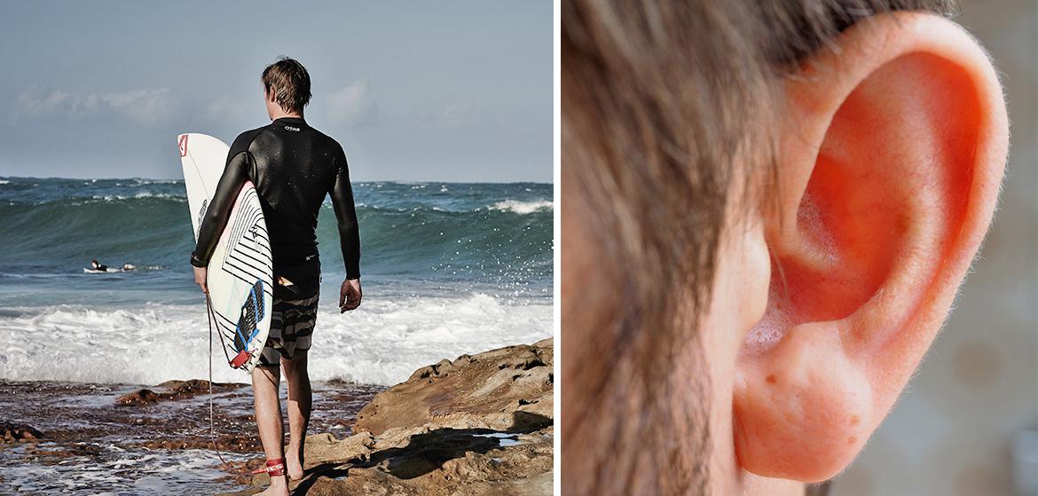 Exostose : Comprendre la maladie des surfeurs