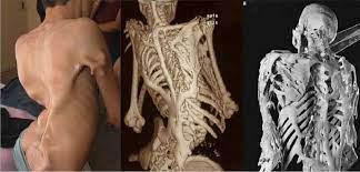 Patient bizarre : la maladie qui transforme les muscles en « pierre »