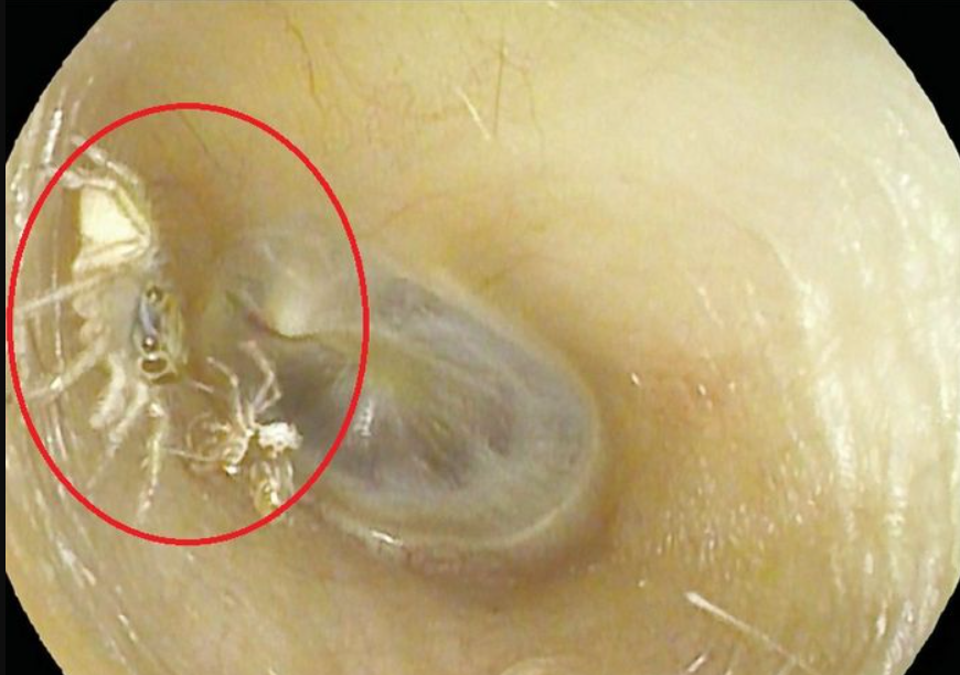 Elle entend des “bruissements” durant des jours, les médecins trouvent une araignée dans son oreille"