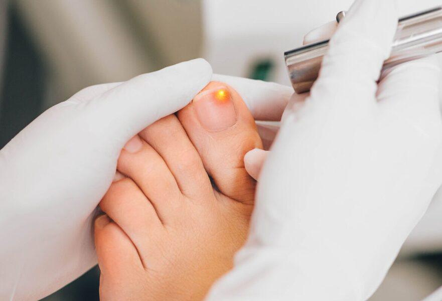 Le curcuma : un remède naturel contre les mycoses des ongles