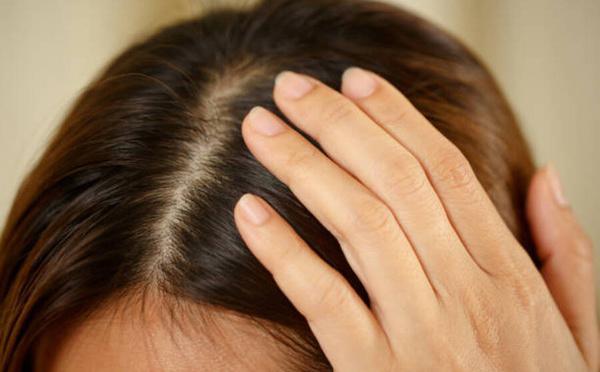 Cuir chevelu irrité ? Ces solutions naturelles vont vous sauver la mise