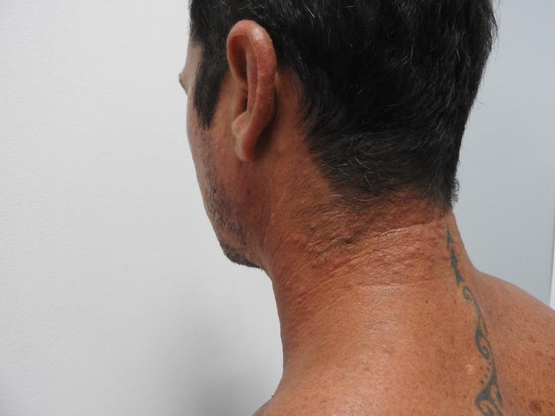 Dermatite Du Surfeur Le Phenomene Se Propage Dans Les Iles Dermatite Du Surfeur Le Phenomene Se Propage Dans Les Iles