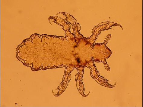 Page Enfant Poux Et Lentes