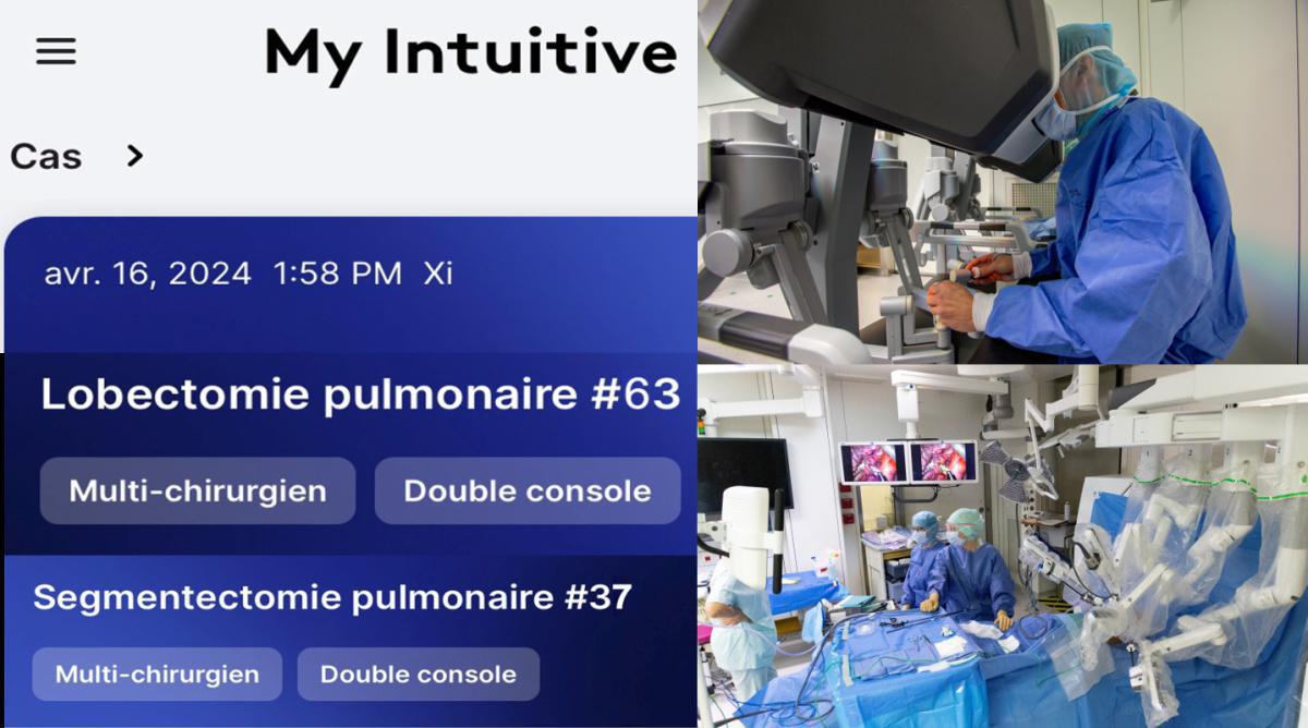 Le service de chirurgie thoracique des HUS réalise sa 100ème opération avec le robot DaVinci