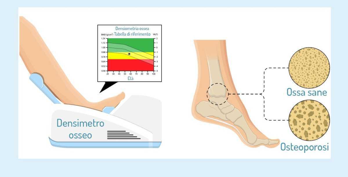 Densitometria ossea Densitometria ossea