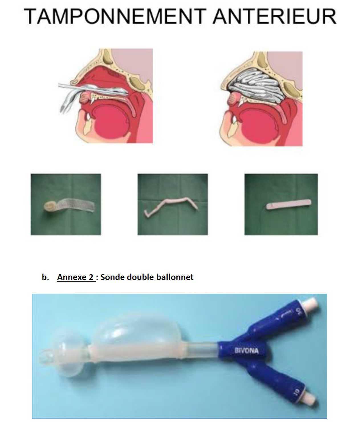 Protocole Epistaxis