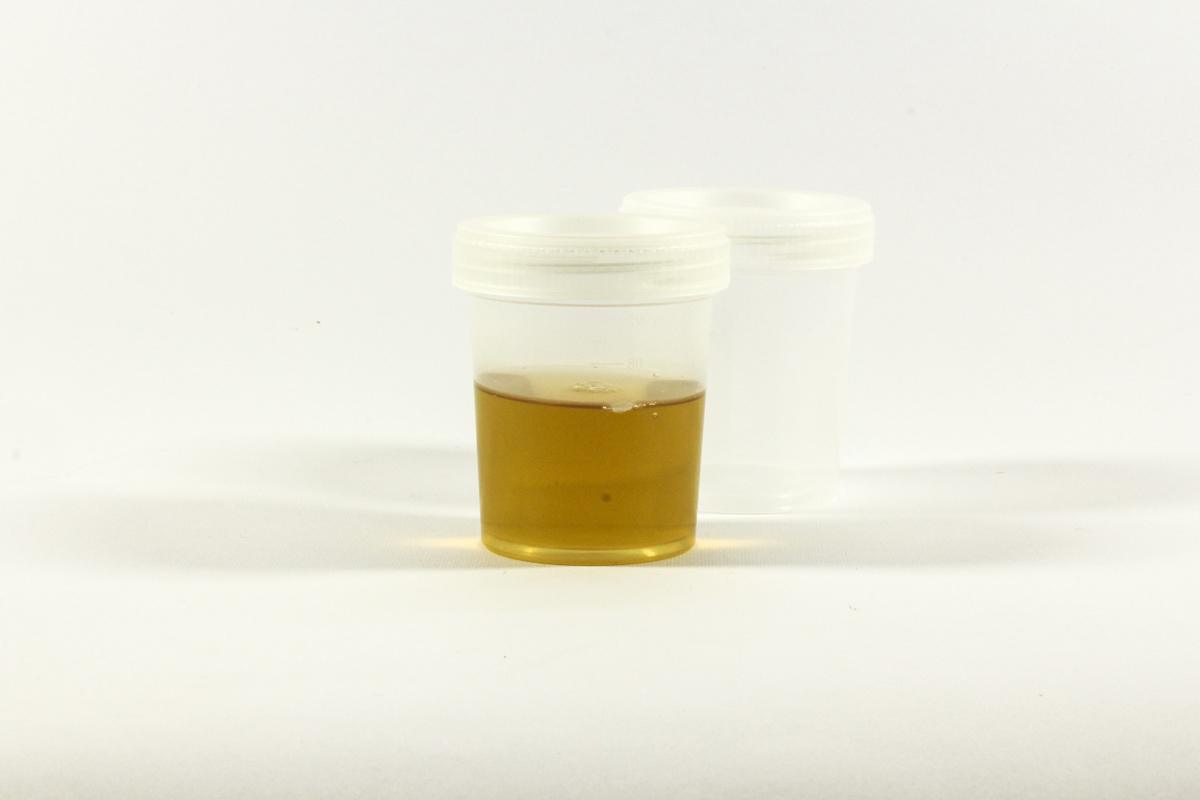 Ratio Albumine/créatinine