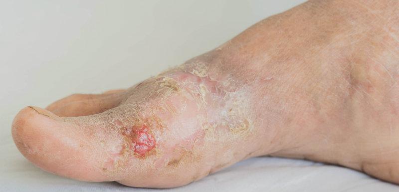 Infections cutanée