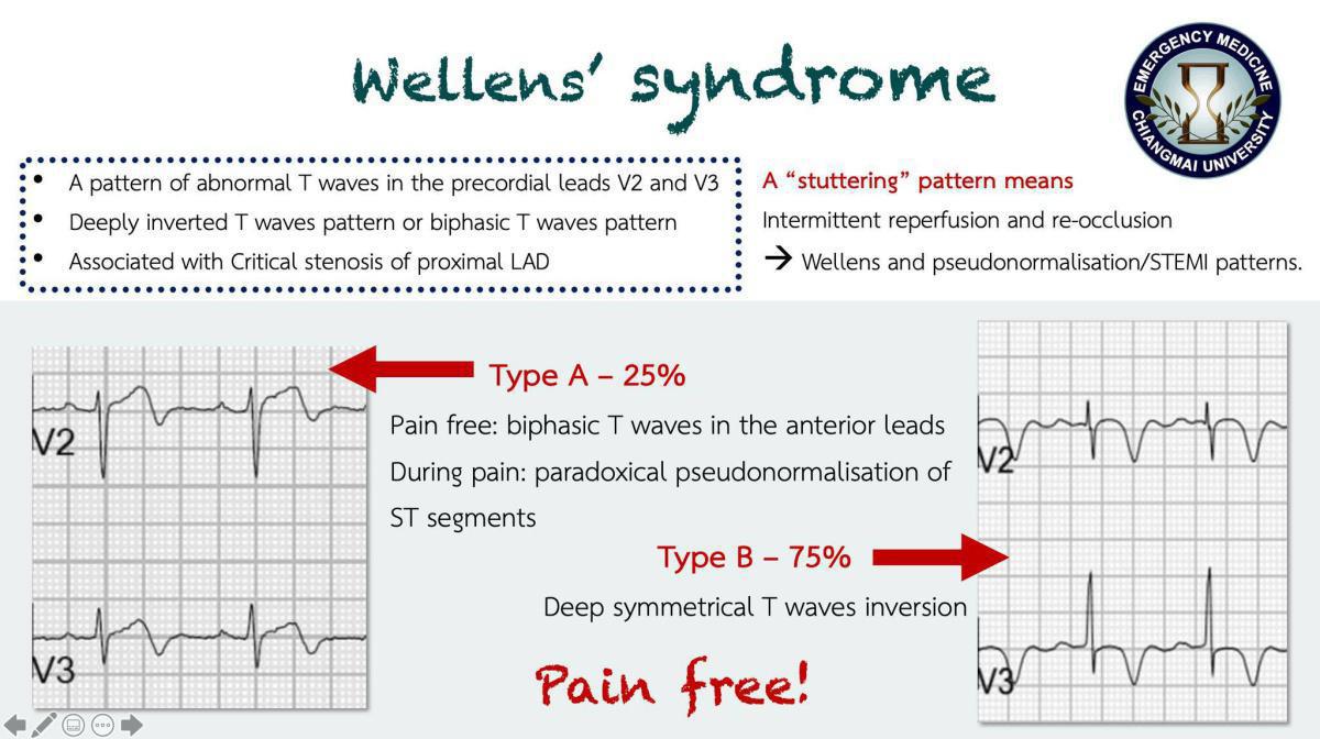 Wellens