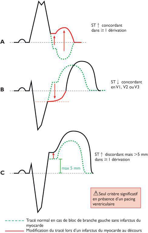 BBG : critères de Sgarbossa