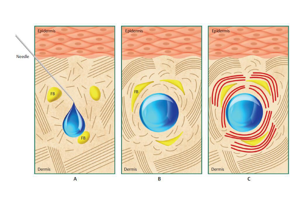 ¿Qué es el acido Hialuronico?
