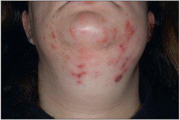 Todo lo que debes sabes sobre la Depilación Láser Medica