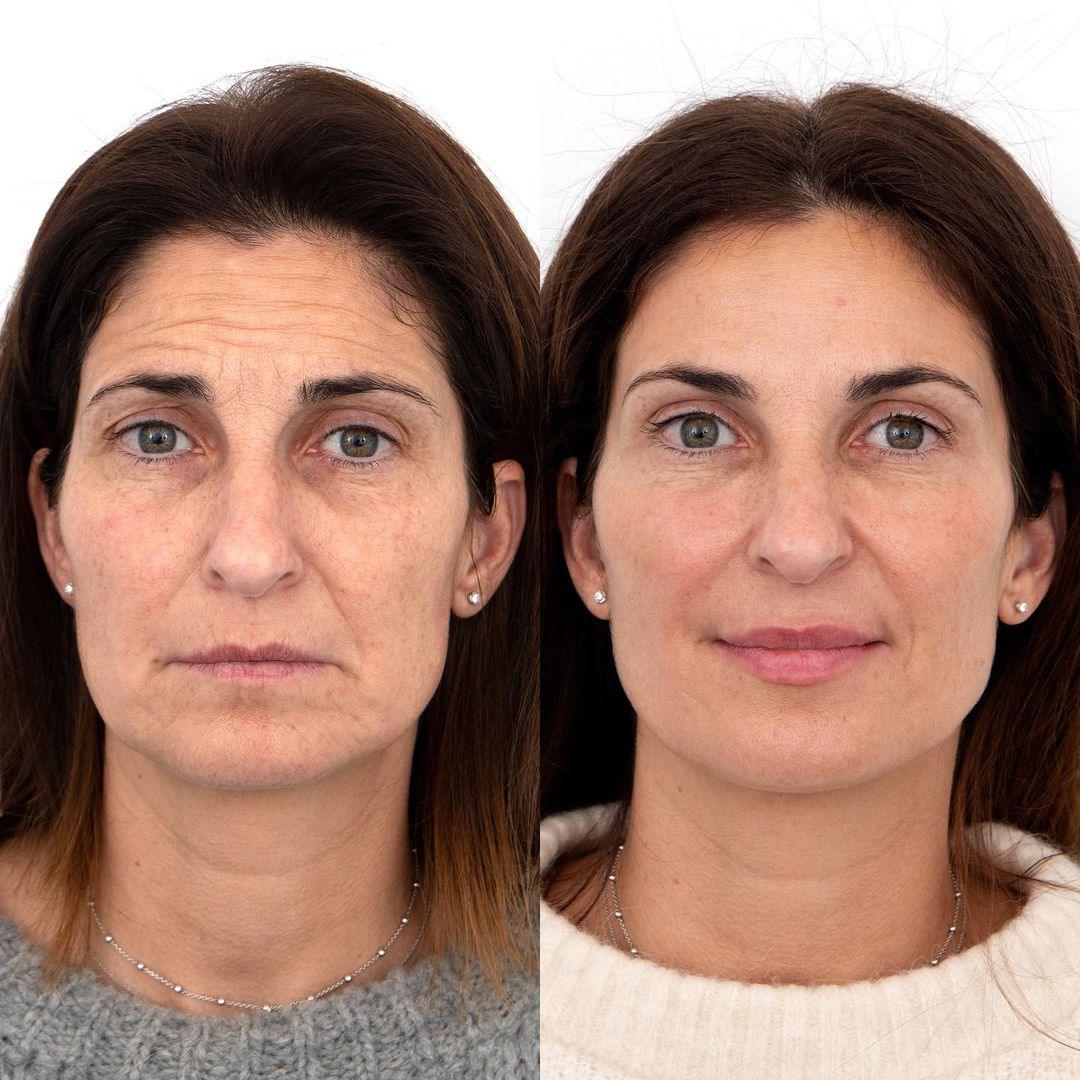 Botox y Relleno de Labios