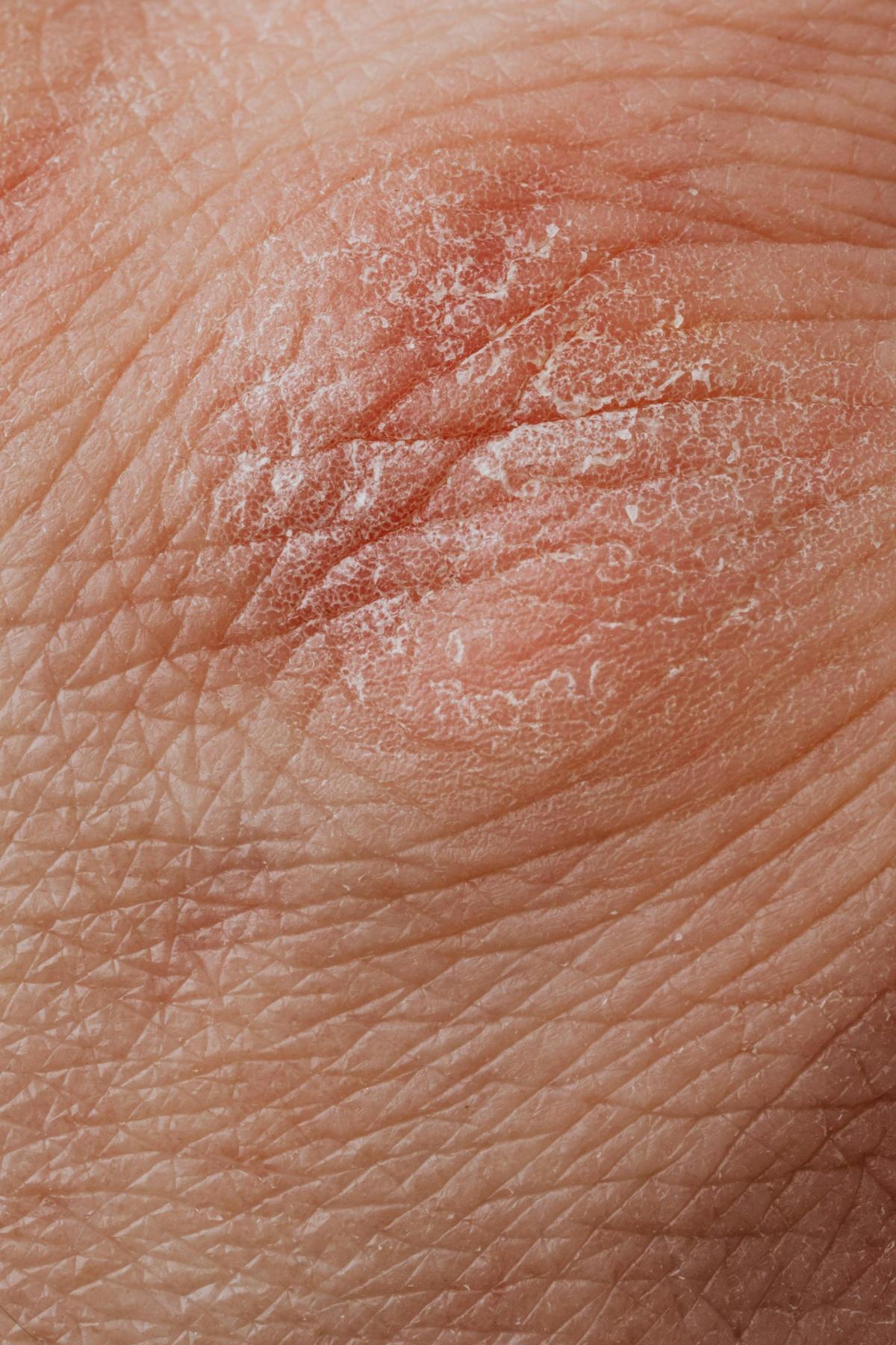 Psoriasis
