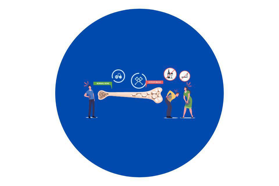 L'alimentazione può combattere l'avanzare dell'osteoporosi L'alimentazione può combattere l'avanzare dell'osteoporosi