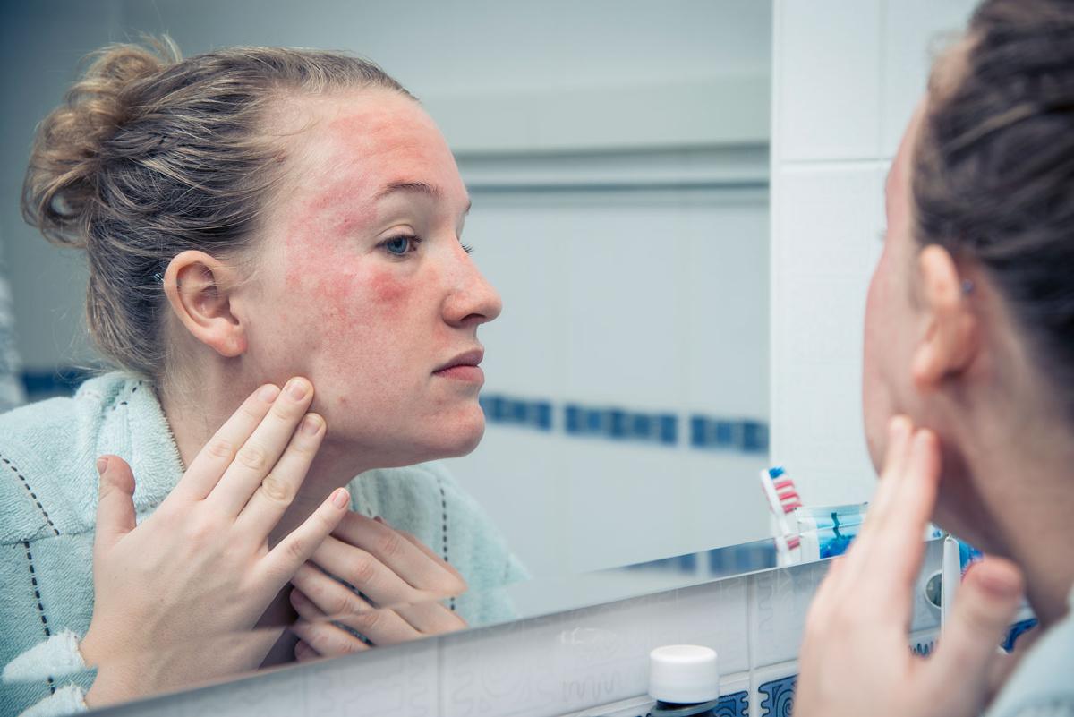 What causes contact dermatitis?