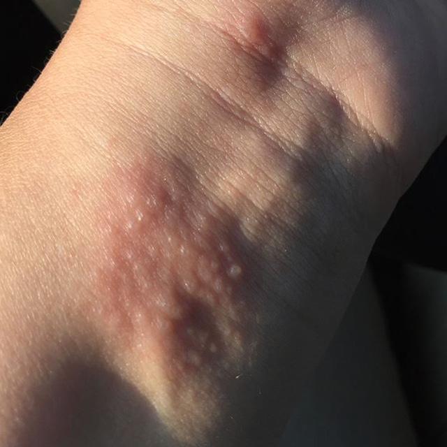 Poison ivy rash on wrist.