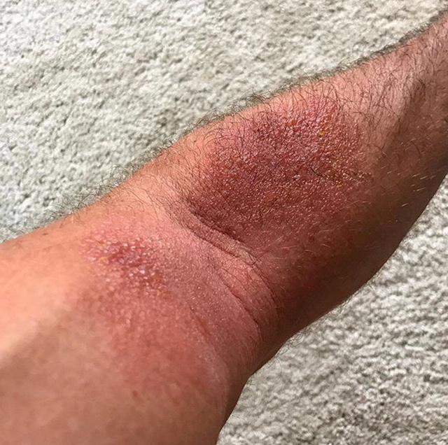 Poison ivy rash in the bend of an arm.