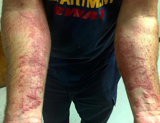 Severe poison ivy rash on both arms.