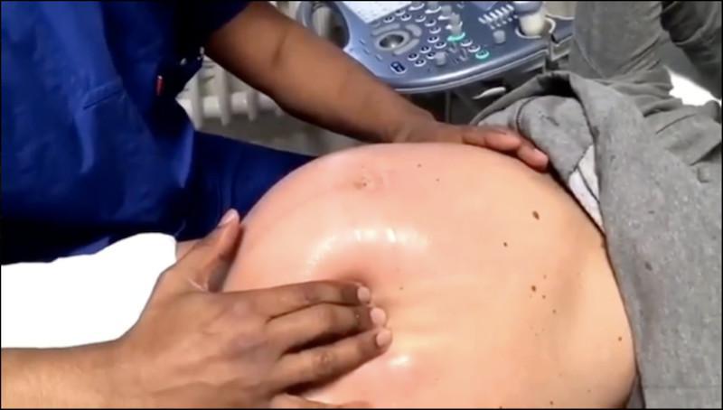 👶 Un obstétricien allemand transforme les bébés dans le ventre de leur mère pour éviter une césarienne