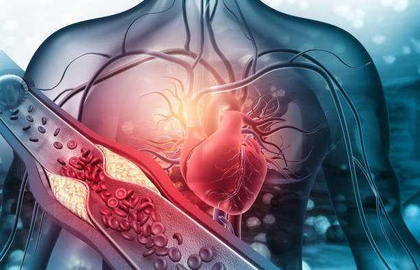 Malattie cardiovascolari e colesterolo Malattie cardiovascolari e colesterolo