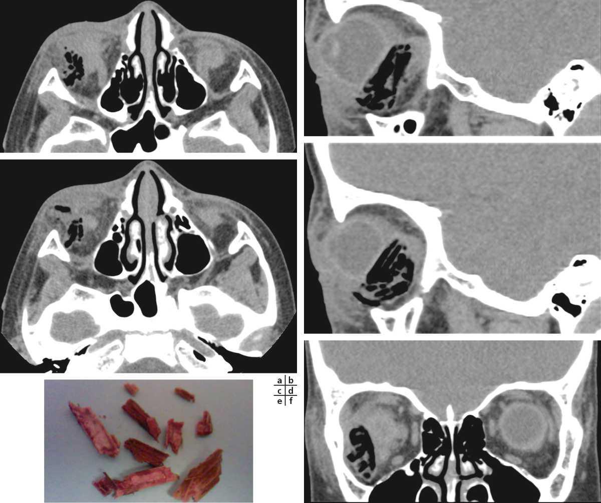 CHAPITRE 6 Exploration d’urgence en ophtalmologie