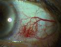OEil rouge OEil rouge