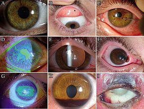 OEil rouge OEil rouge