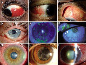OEil rouge OEil rouge