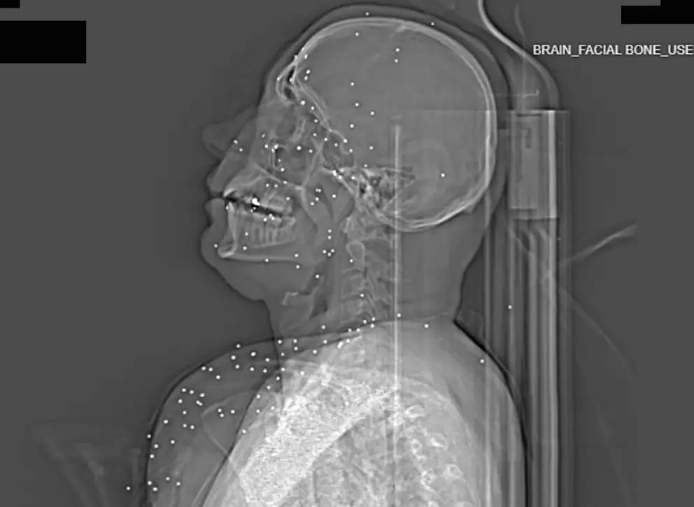 رصاص الخرطوش في قلب المتظاهرين: صور أشعة تكشف استهدافًا متعمّدًا للأجساد في الاحتجاجات الإيرانية رصاص الخرطوش في قلب المتظاهرين: صور أشعة تكشف استهدافًا متعمّدًا للأجساد في الاحتجاجات الإيرانية