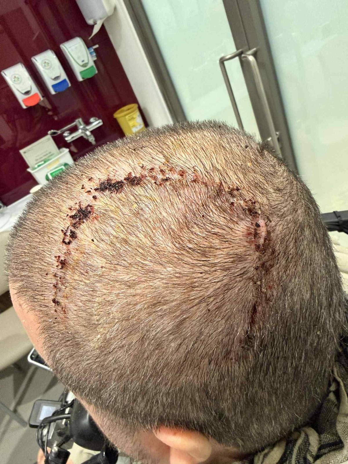 رائد تجربة «نيورالينك» يكشف مئة يوم مع الشريحة الدماغية رائد تجربة «نيورالينك» يكشف مئة يوم مع الشريحة الدماغية