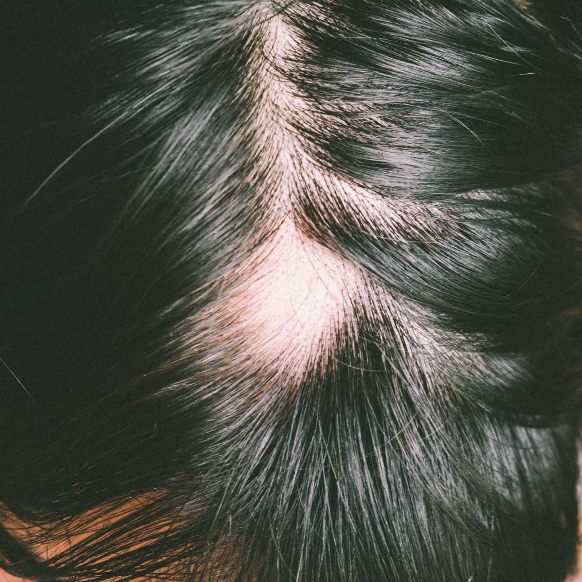 Alopecia