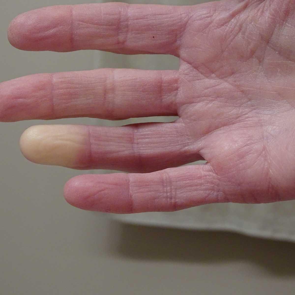 Síndrome de Raynaud