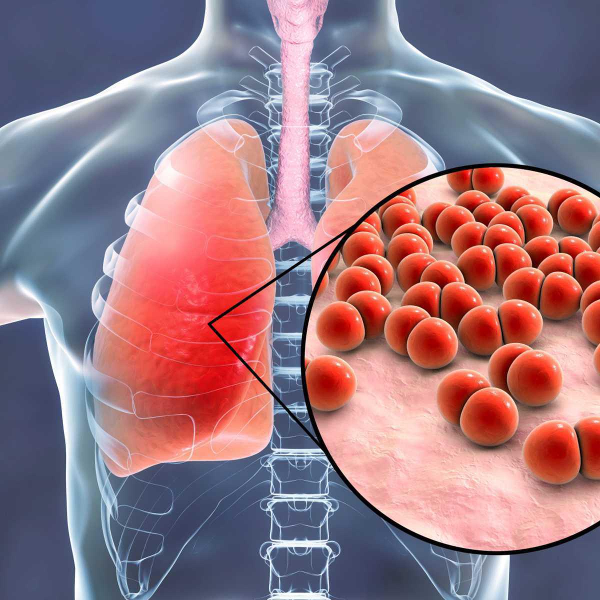 Pneumonia viral ou bacteriana