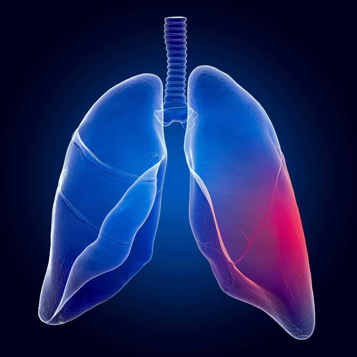 Fibrose pulmonar