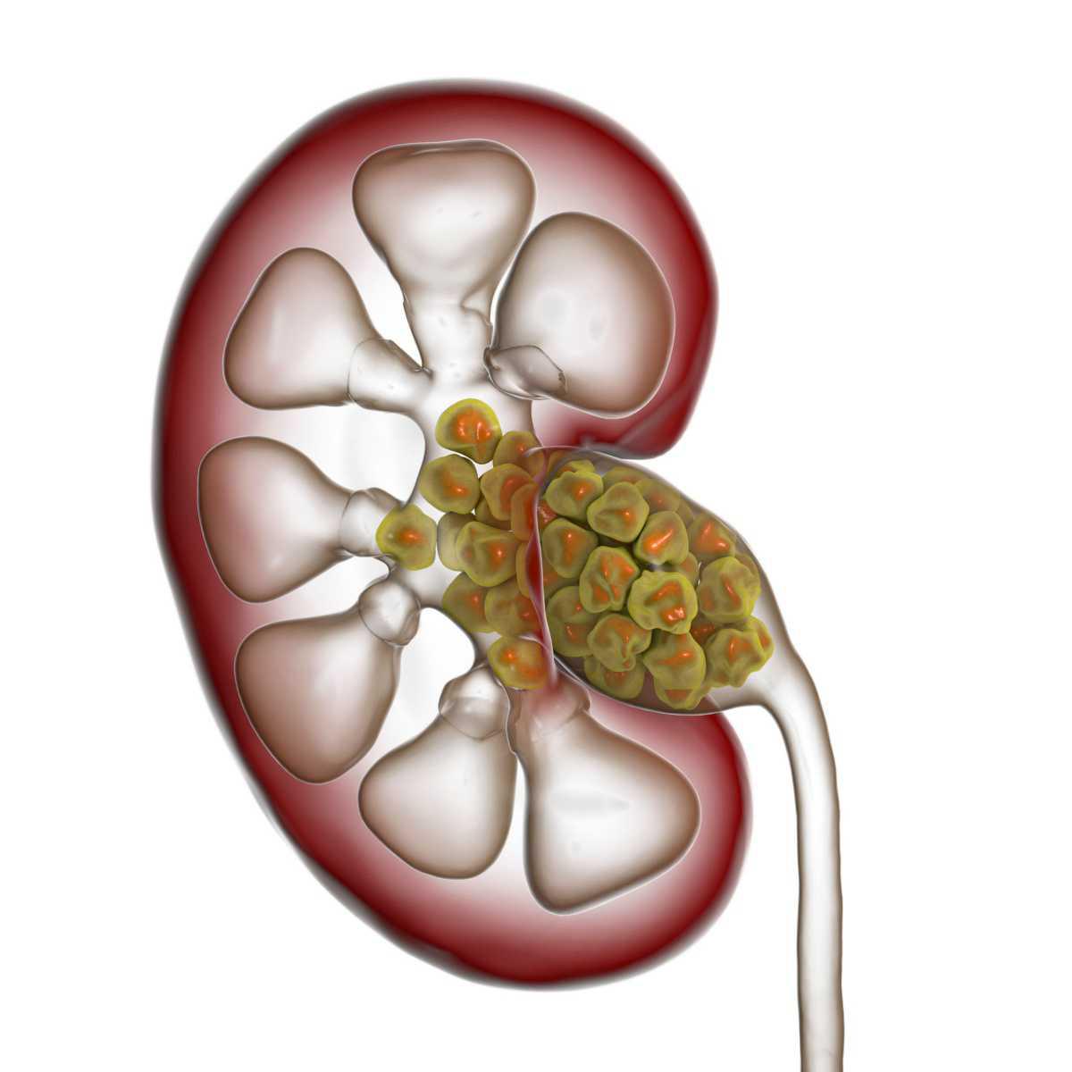 Cálculo renal / Pedra nos rins 